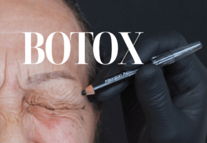 botox roma, medicinaesteticaroma, rughe roma