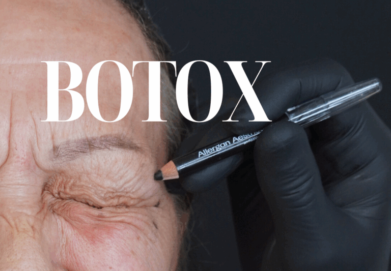 botox roma, medicinaesteticaroma, rughe roma